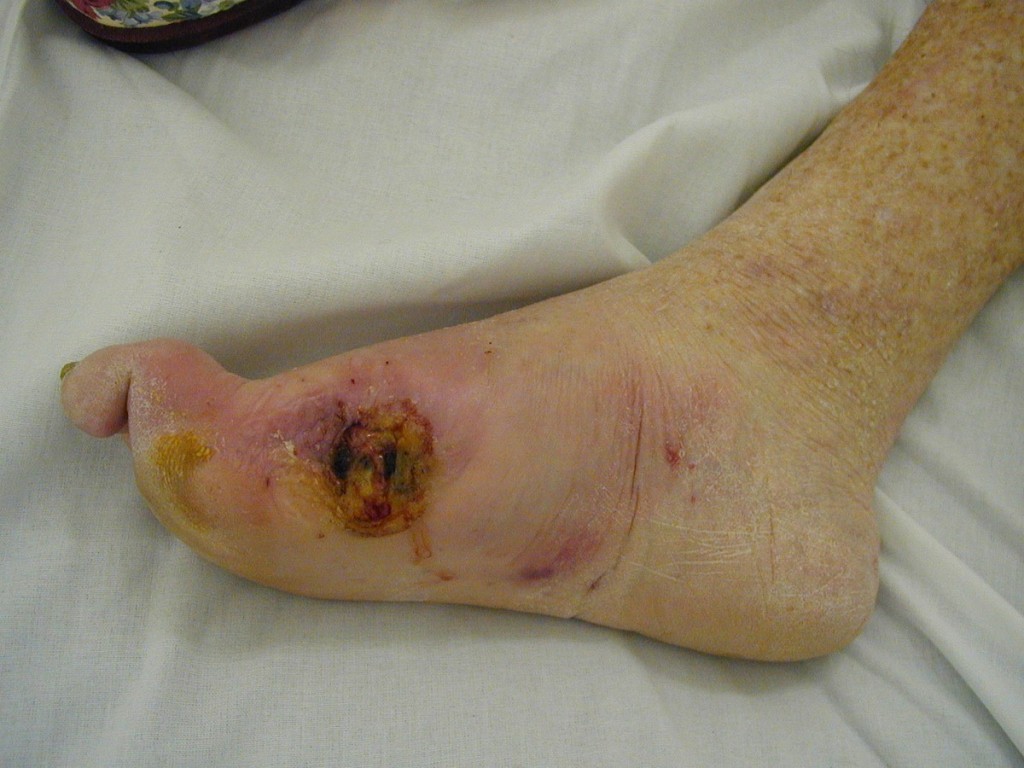 A diabetic foot with necrosis.