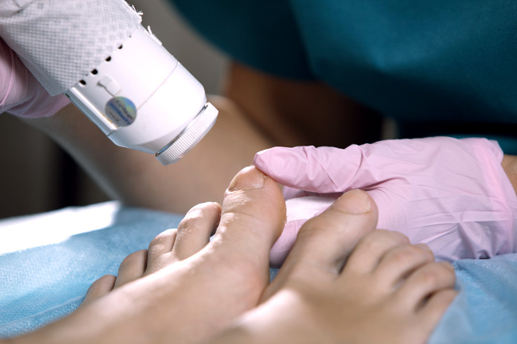 fungal nail infection laser treatment