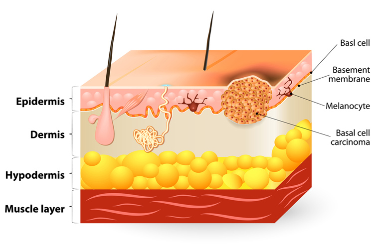 Focus on Skin Cancer: An Overview | Ausmed