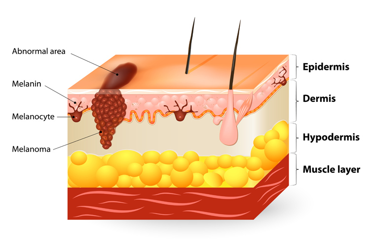 melanoma