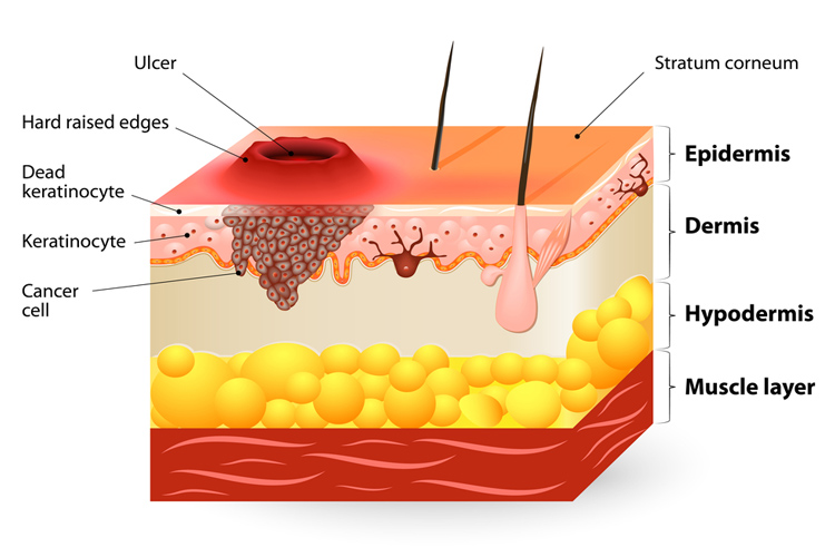 Squamous Cell Carcinoma