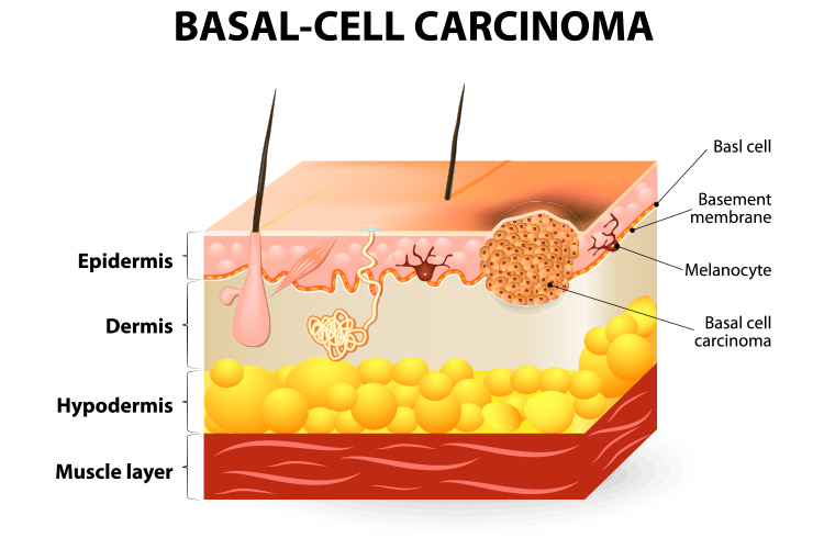 basal cell carcinoma diagram