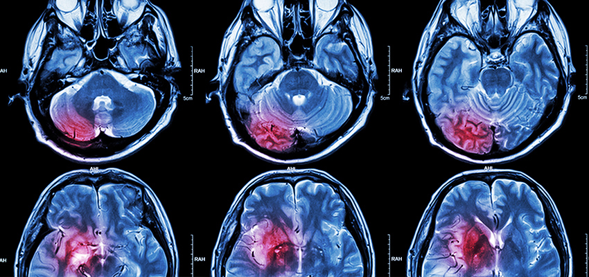 Cover image for article: Aphasia – Care and Management of Post-Stroke Receptive Aphasia