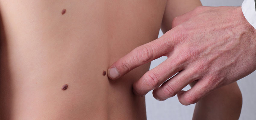 Cover image for article: Dysplasia to Invasion: Squamous Cell Carcinoma (SCC)
