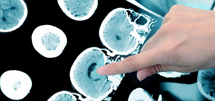 Cover image for article: Multiple Sclerosis and Nursing Care