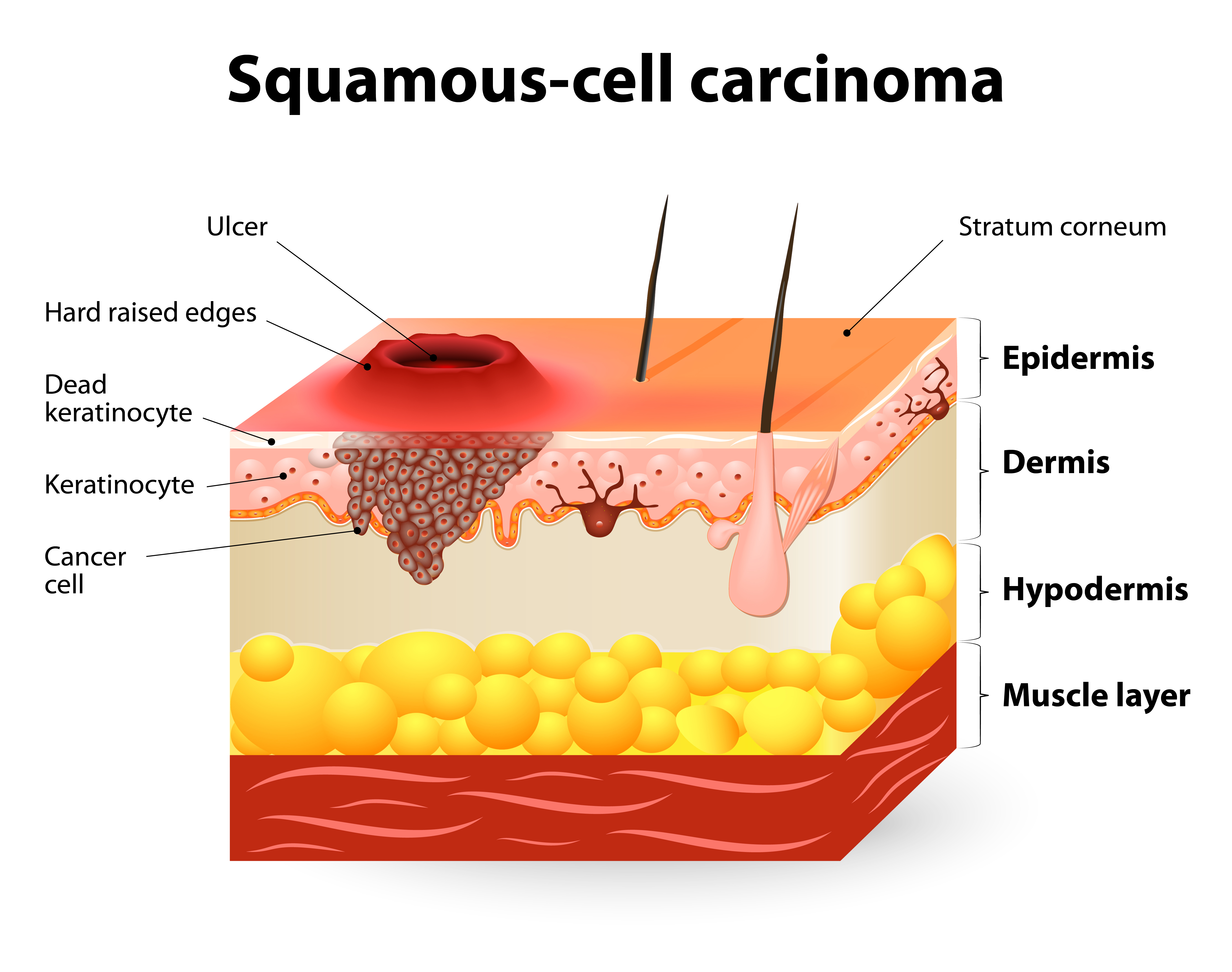 Basal Cell Carcinoma Scalp Treatment