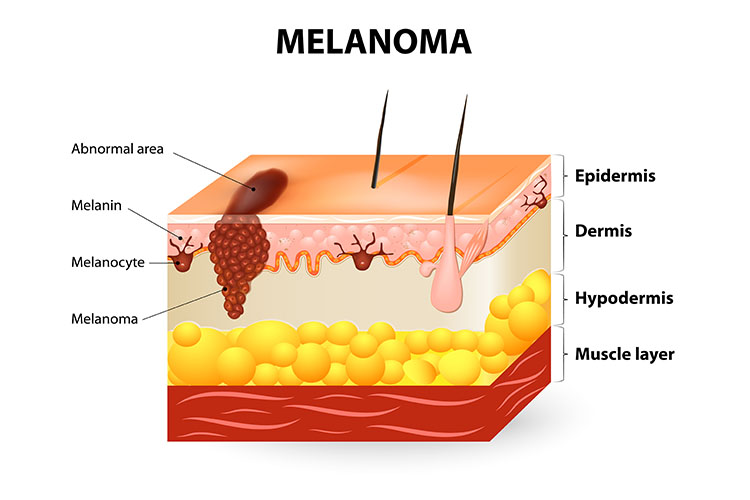 melanoma diagram