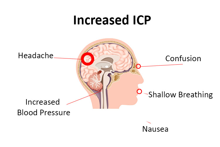 Increased Intracranial Pressure A Guide For Nurses Ausmed