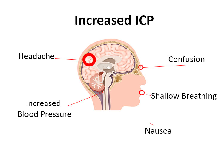 increased-intracranial-pressure-a-guide-for-nurses-ausmed