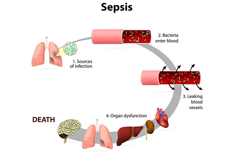 what-is-sepsis-clinical-guidelines-for-nurses