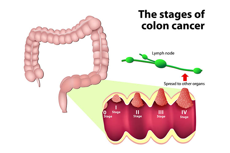 colon cancer staging