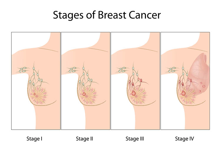 breast cancer staging