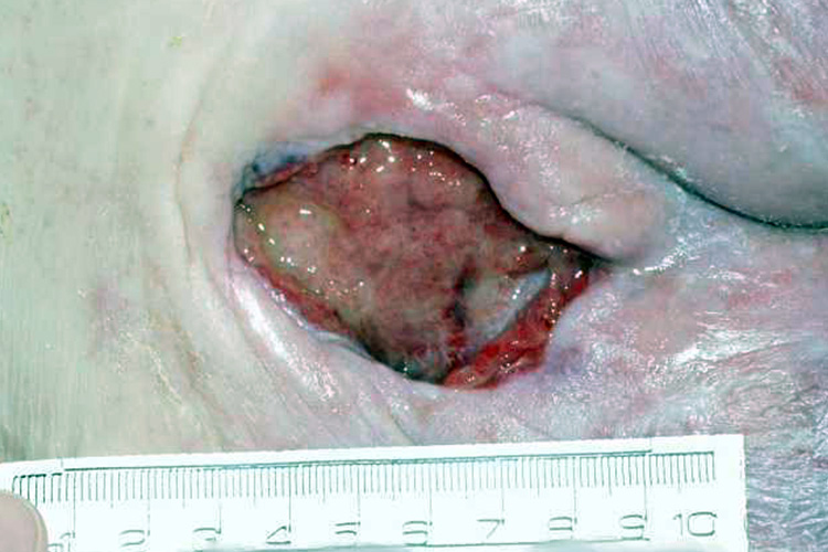 Pressure Injuries and Ulcerations