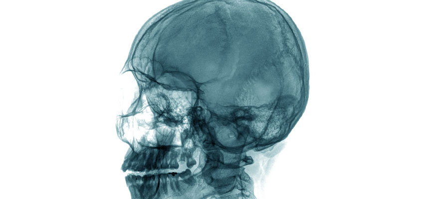 Cover image for article: Traumatic Brain Injuries