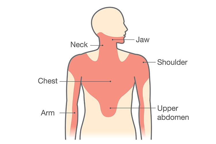 Anatomie des sites courants de douleurs irradiantes dans les douleurs thoraciques liées à l'IAM | Image