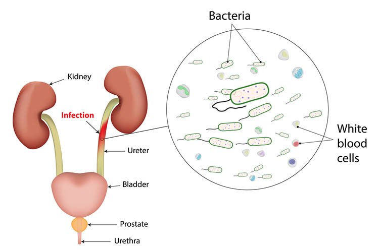 treating-urinary-tract-infections-without-antibiotics