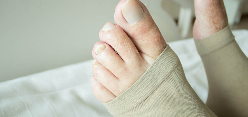 Cover image for article: Venous Thromboembolism: Symptoms and Prevention