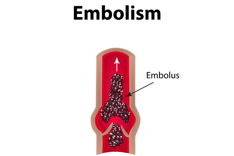 venous thromboembolism