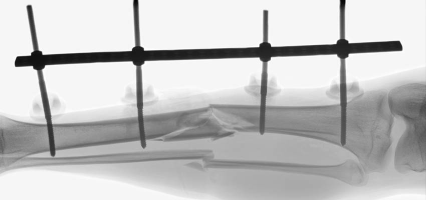 Cover image for article: Nursing Care of External Fixation Devices