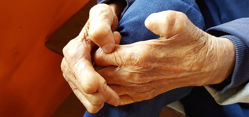 Cover image for article: World Leprosy Day: 29th of January – What Do You Really Know About Leprosy?