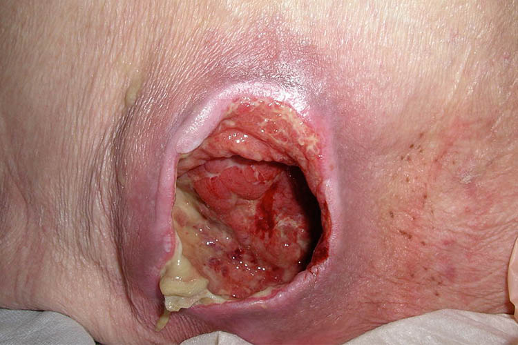 Ausmed's Wound Care and Wound Healing Guide for Nurses A stage four pressure wound.