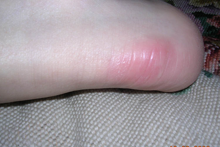 Ausmed's Wound Care and Wound Healing Guide for Nurses A stage one pressure wound.