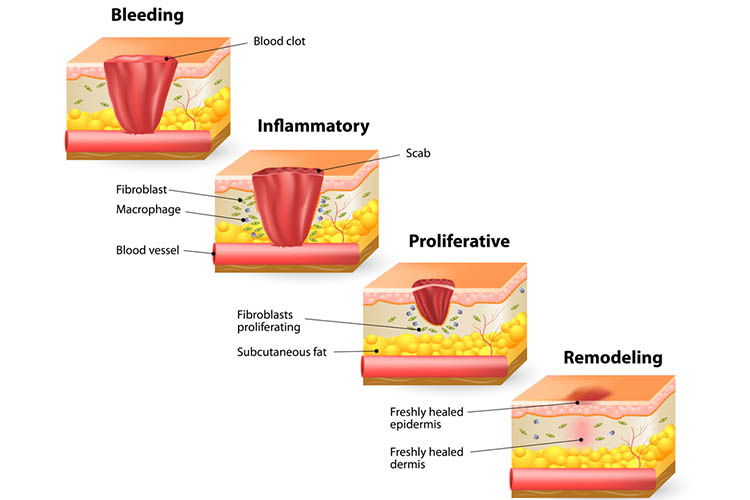 Ausmed's Wound Care and Wound Healing Guide for Nurses The wound healing process.