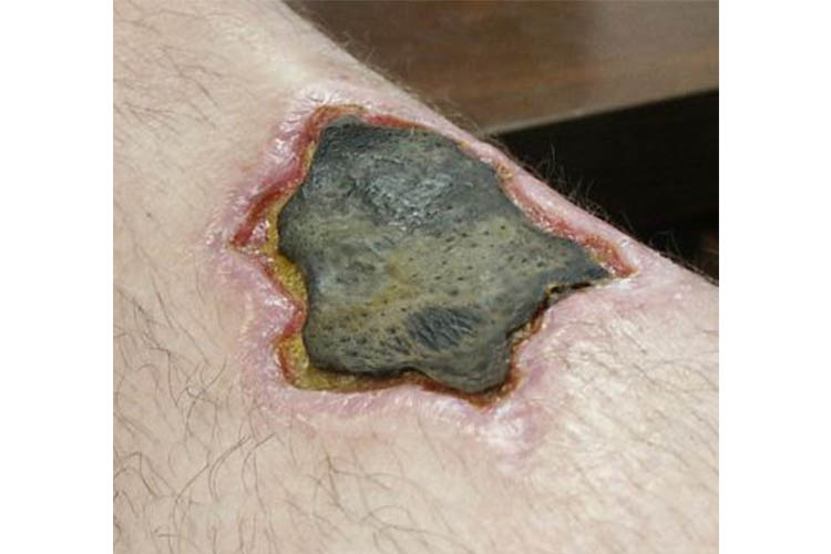 Ausmed's Wound Care and Wound Healing Guide for Nurses Necrotic leg wound.