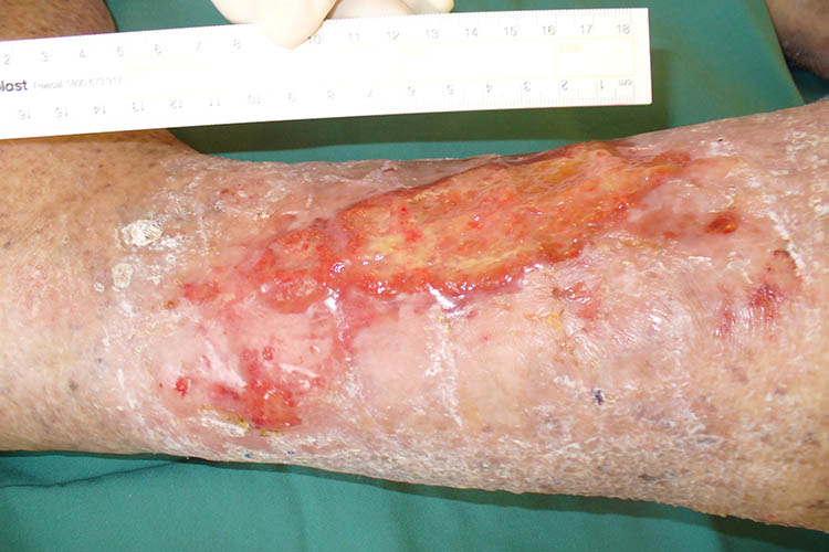 Ausmed's Wound Care and Wound Healing Guide for Nurses Venous ulcer on leg.