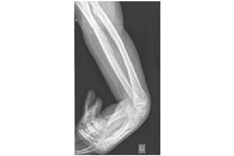 X-ray image of forearm | Image