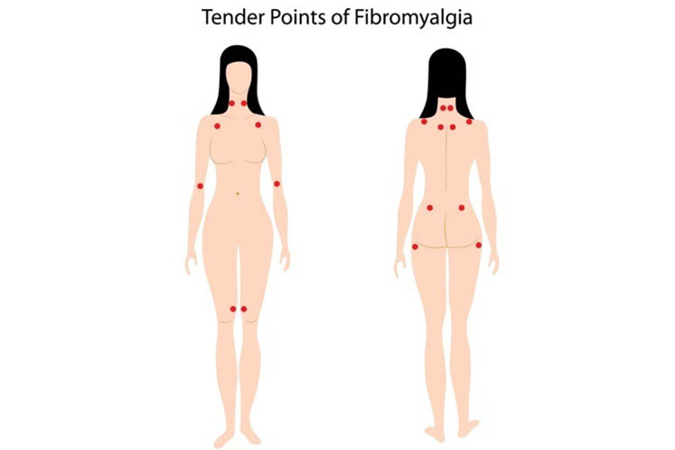 fibromyalgia tender points