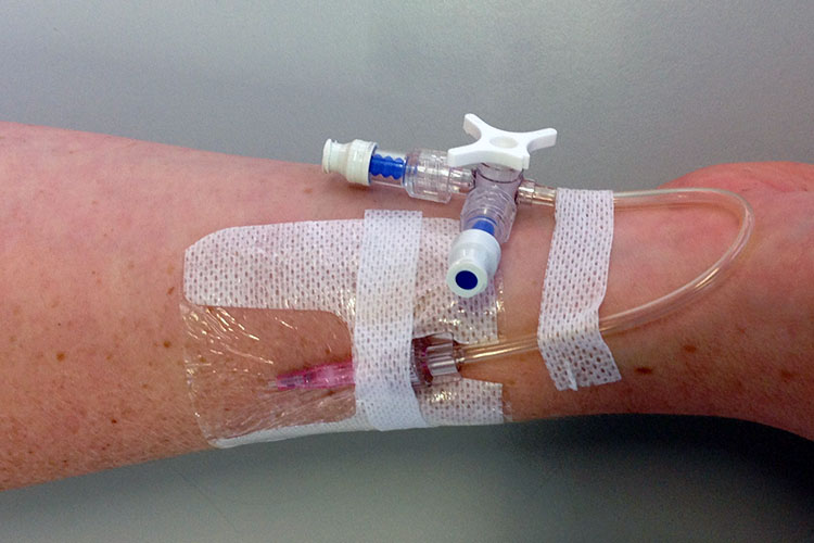 peripheral intravenous cannula in patient's arm