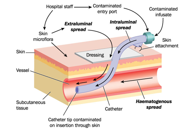cannula infection diagram