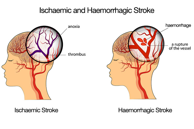 ischaemic vs haemorrhagic stroke diagram