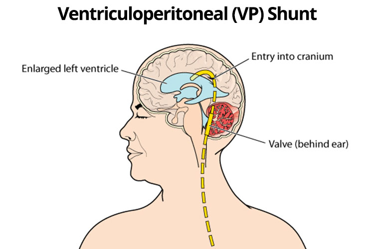 Ventriculoperitoneal (VP) Shunt diagram