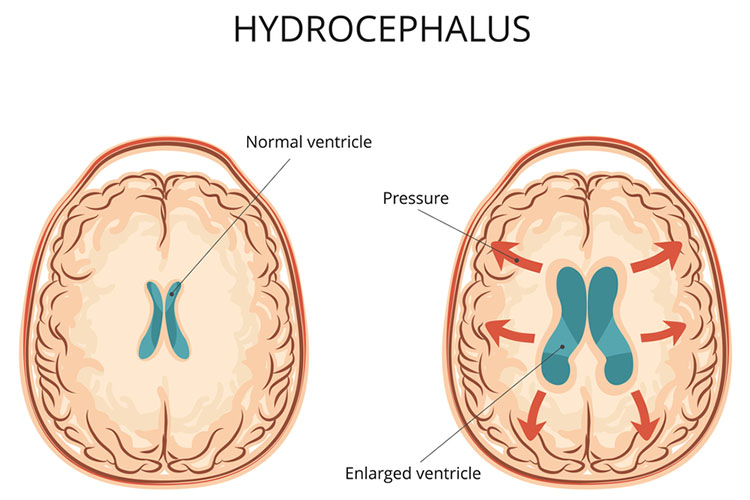 Hydrocephalus diagram