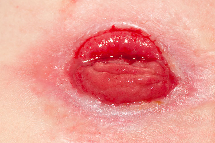 stoma care in the home site