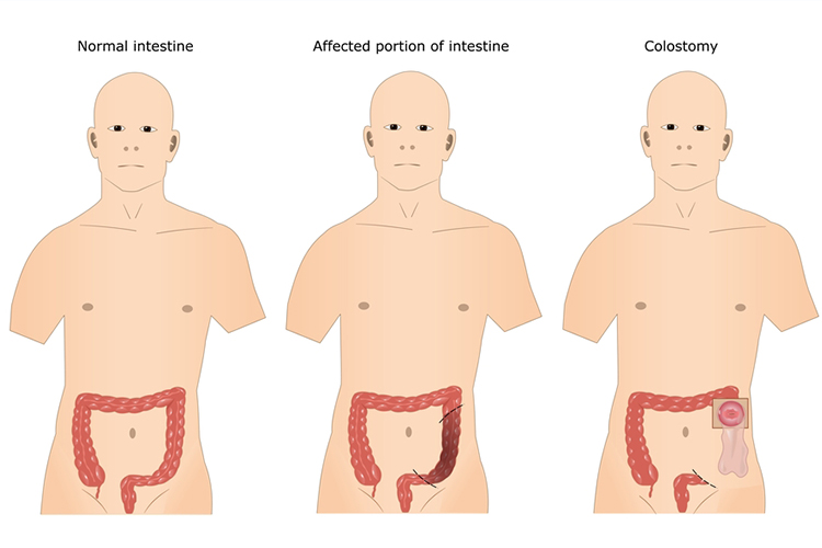 Diagram of a colostomy