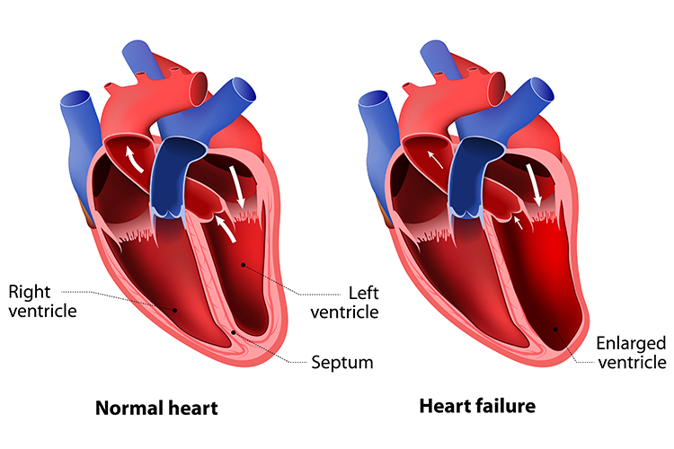 Congestive Heart Failure - Common Reasons for CHF