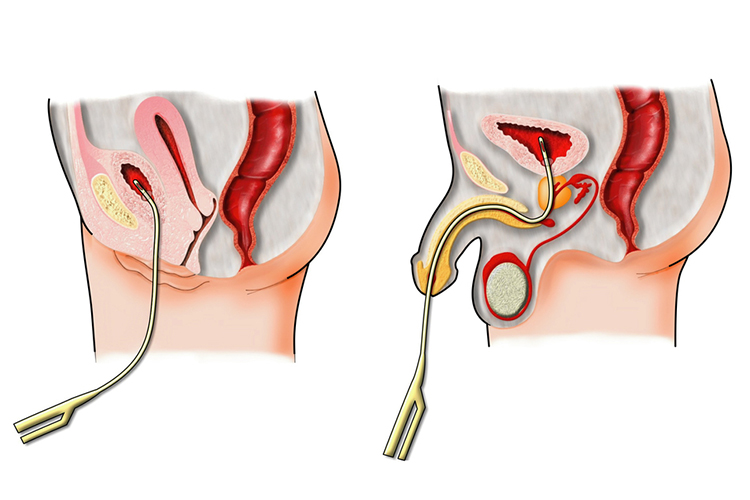 Urinary Catheters in situ