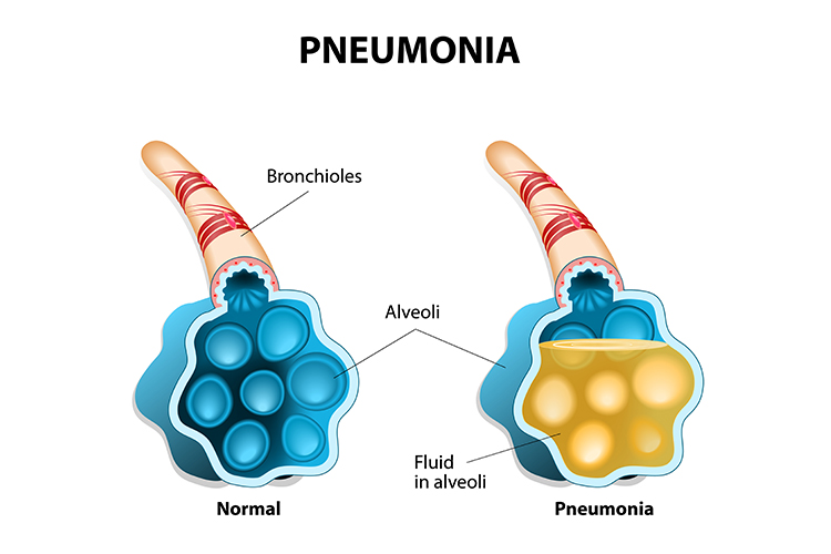 diagrama pneumoniei