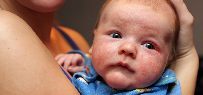 Cover image for article: Eczema Myth-Busting