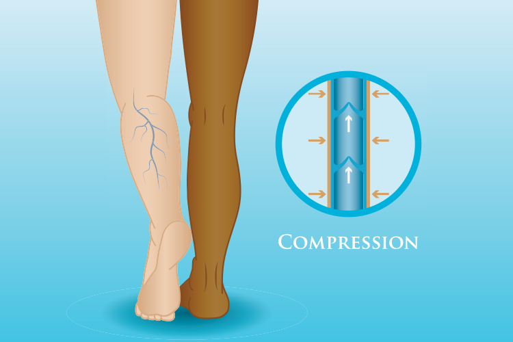 compression therapy. Pulmonary Embolism (PE) - DVT to PE, Symptoms, Treatment & Causes