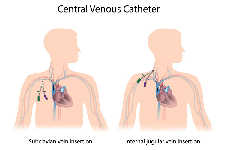 Central Line-Associated Bloodstream Infections (CLABSI)
