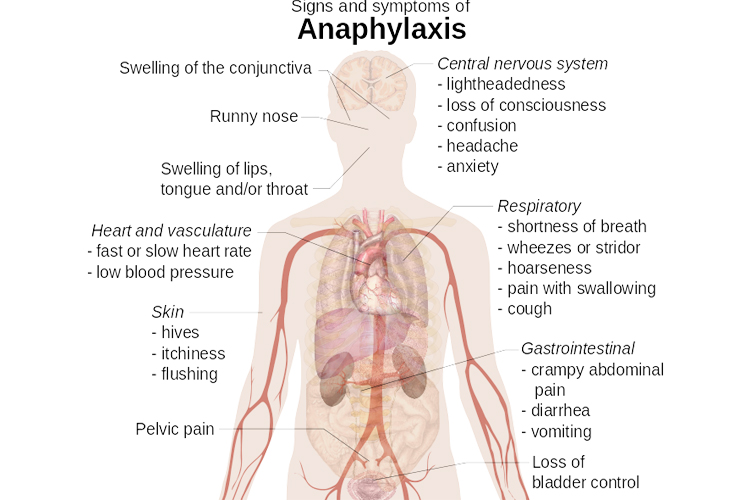 anaphylaxis-and-treatment-of-an-anaphylactic-reaction