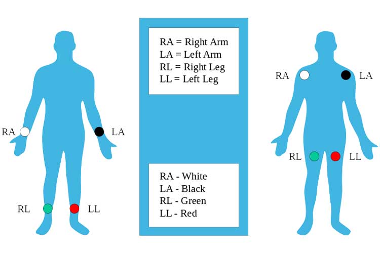 Ecg Electrode Placement Chart