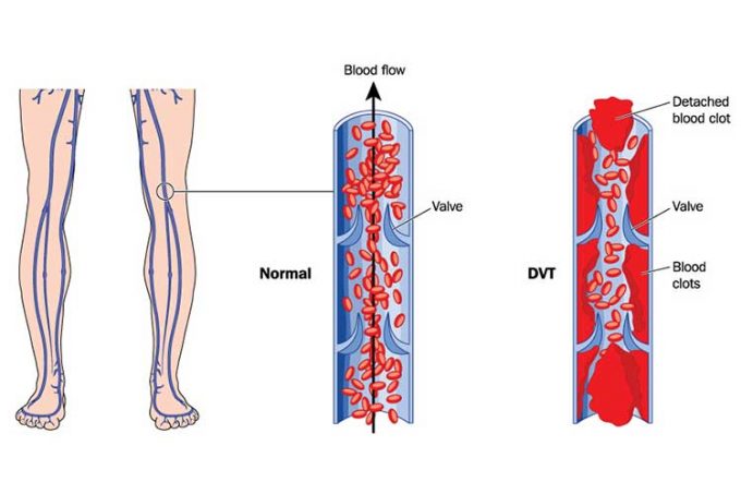 pulmonary-embolism-dvt-to-pe