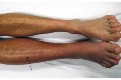 Pulmonary Embolism – DVT to PE