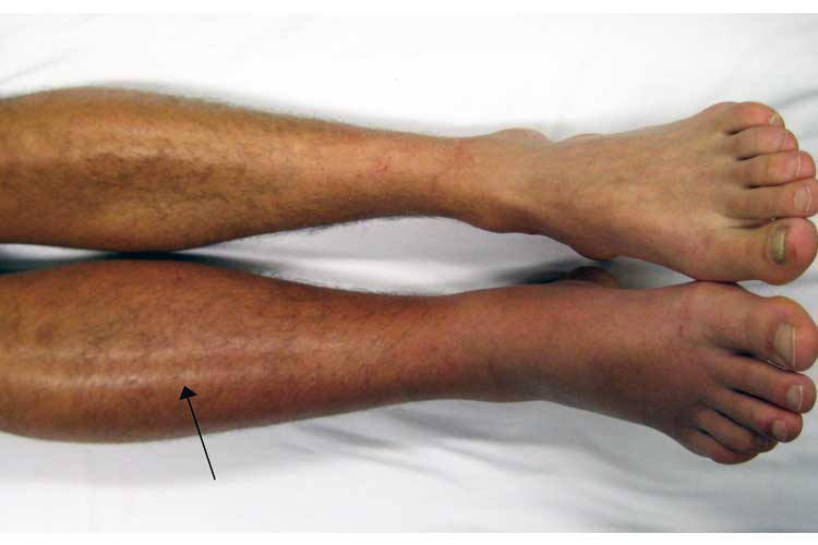 A deep vein thrombosis on the right leg Pulmonary Embolism (PE) - DVT to PE, Symptoms, Treatment & Causes