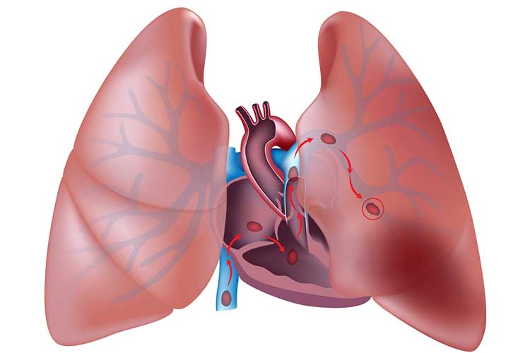 migrations of a thrombis into a Pulmonary Embolism (PE) - DVT to PE, Symptoms, Treatment & Causes